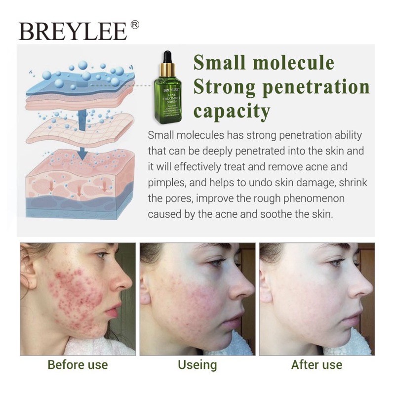 Breylee Penghilang Jerawat serum wajah acne pemutih kulit wajah skincare 17ml