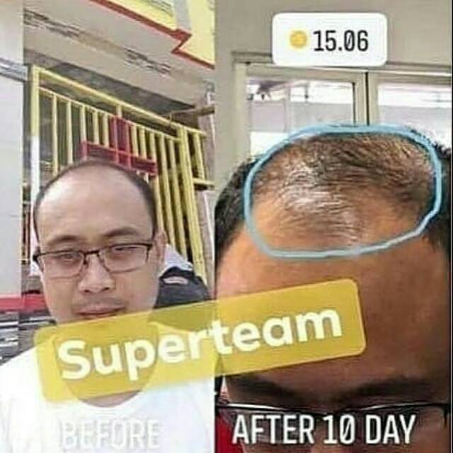 Menumbuhkan rambut
