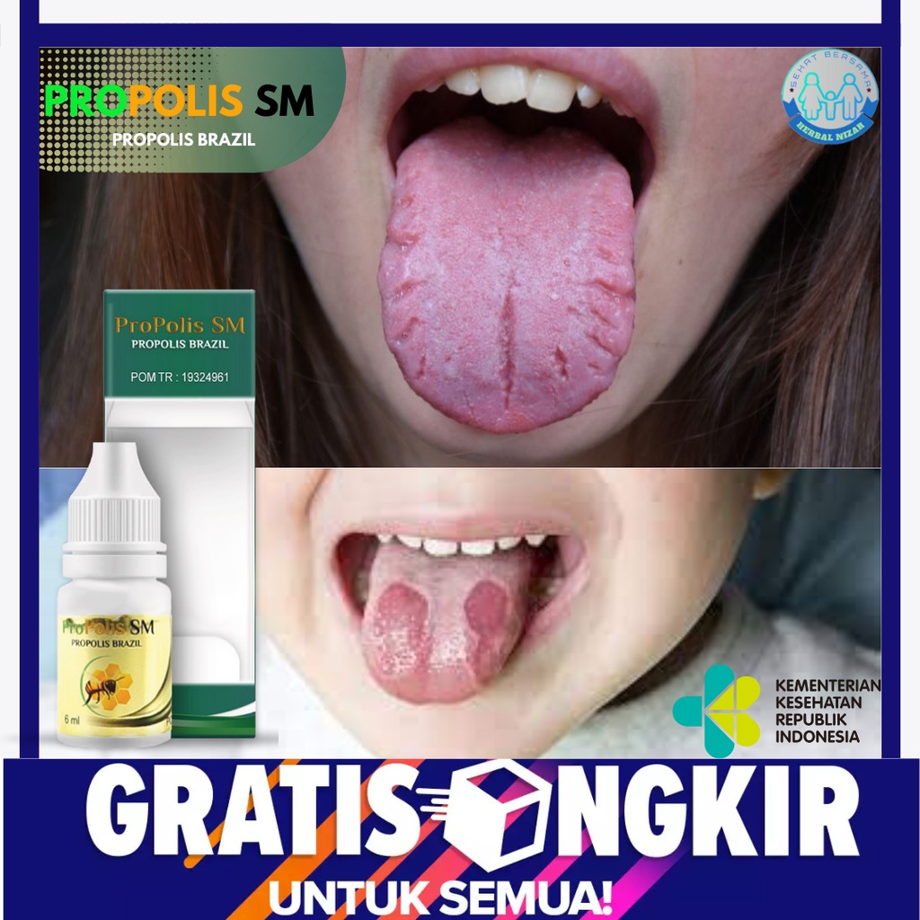 Obat Lidah Berjamur, Obat Infeksi Lidah Putih, Obat Lidah Pecah Pecah, Obat Bagus Buat Lidah, Obat R