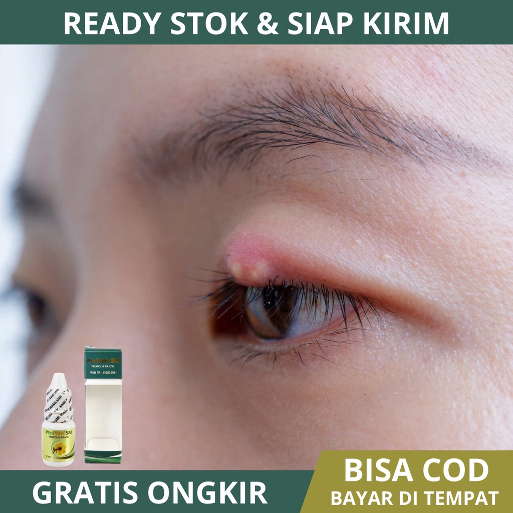 Obat Mata Bintitan, Obat Buat Mata Bintitan, Timbilen, Cindilen, Penghilang Mata Bintitan, Hilangkan