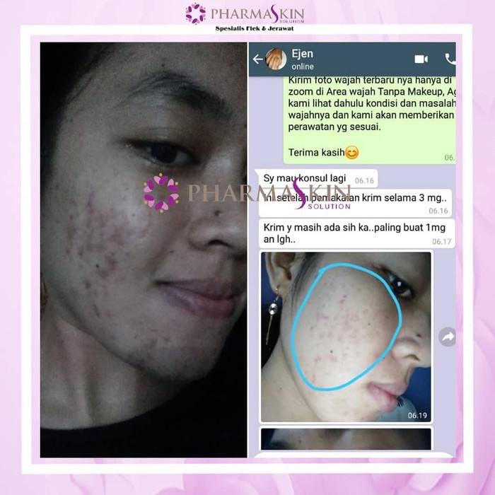 Pharmaskin Paket Full Treatment Acne Glowing Series Bebas Menghilangkan Jerawat Perawatan Wajah Berjerawat Glowing Ampuh Resmi BPOM Halal Original-8
