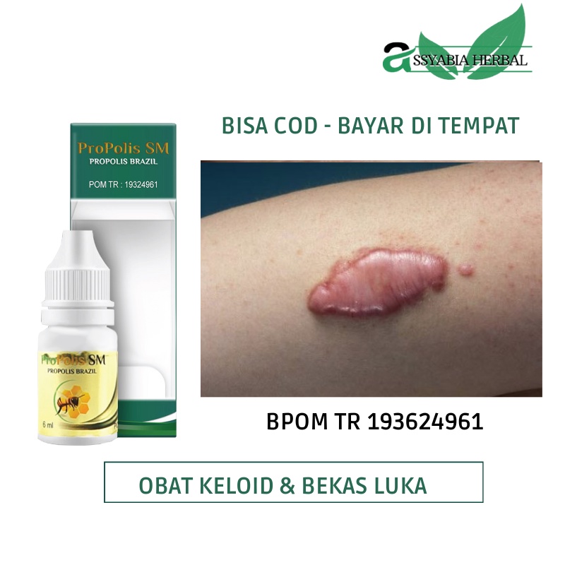 OBAT KELOID - Penghilang Keloid Bekas Luka Menonjol Koreng Operasi Caesar