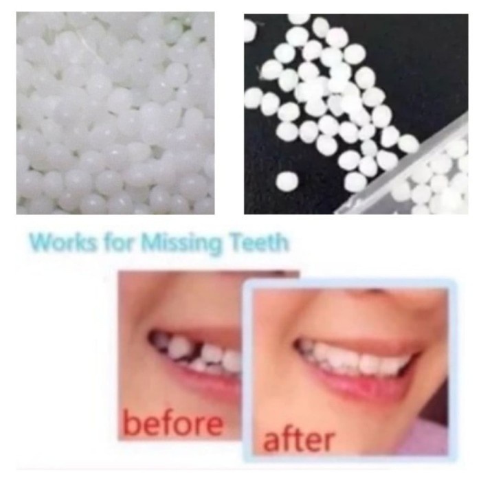 FMFIT Fident Dental Filling