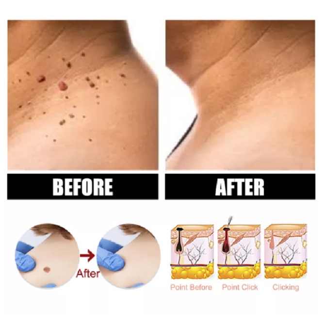 SKIN TAG Obat Penghilang Kutil Tahi Lalat Papiloma