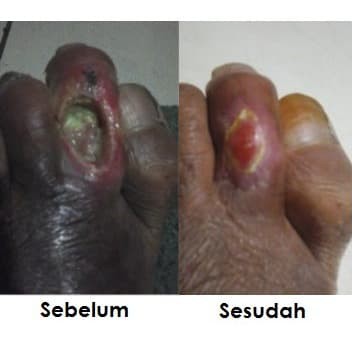 Obat Diabetes Kering Basah Gangren Luka Basah-Kencing Manis - Q N C