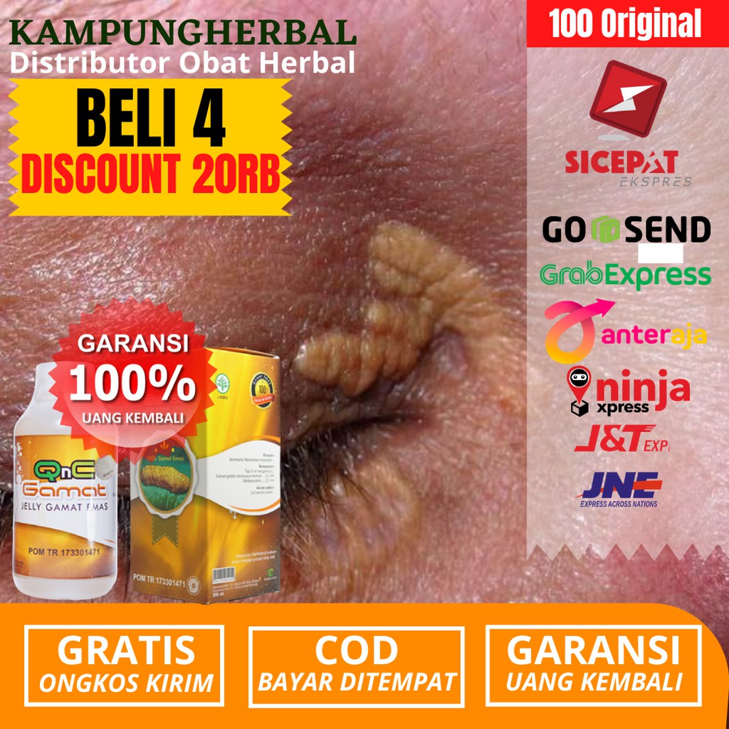 Obat Salep Penyakit Xanthelasma_Obat Oles Penyakit Xanthelasma_Penghilang Gumpalan Lemak Di Kelopak
