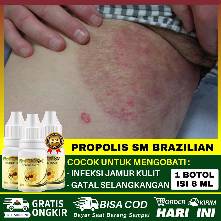 Jual Obat Gatal Selangkangan Kemaluan Lecet Perih di Lipatan Paha