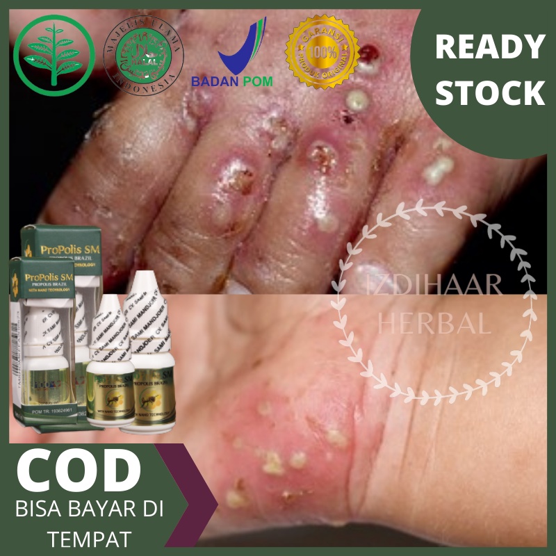 Obat budug/ gudik, Obat Budug Bernanah, Obat Budug Badan Gatal, Obat scabies manusia / kudis, Penghi