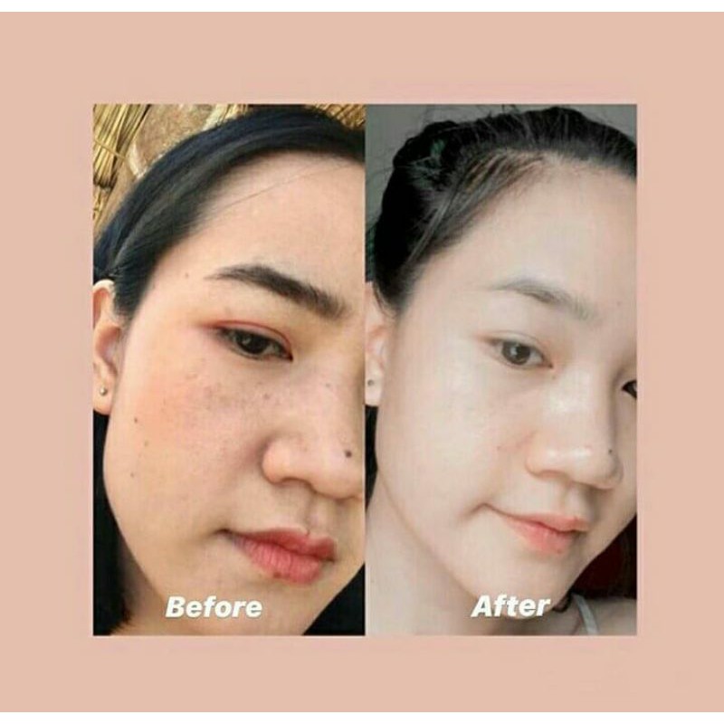 JOJU COLLAGEN ORIGINAL OBAT JERAWAT AMPUH 100% TERMURAH