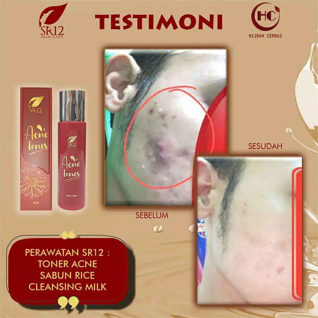 ACNE TONER SR12 / TONER JERAWAT BPOM / OBAT JERAWAT BERUNTUS / PENYEGAR KULIT WAJAH 60 ML