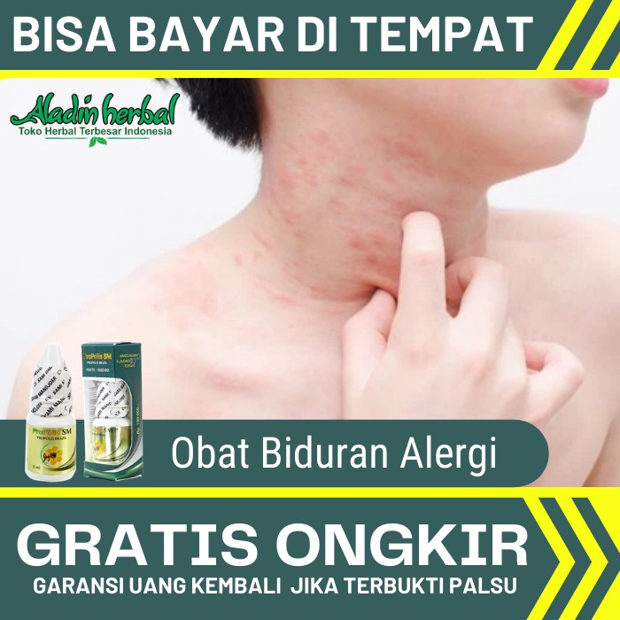 Obat Biduran Alergi - Bentol Biduran, Alergi Dingin, Gatal eksim, Panu dll - PROPOLIS BRAZIL SM