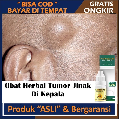 Obat Herbal Tumor Jinak Di Kepala, Penghilang Benjolan Di Kepala, Tumor Ganas Di Kepala, Obat Tumor 
