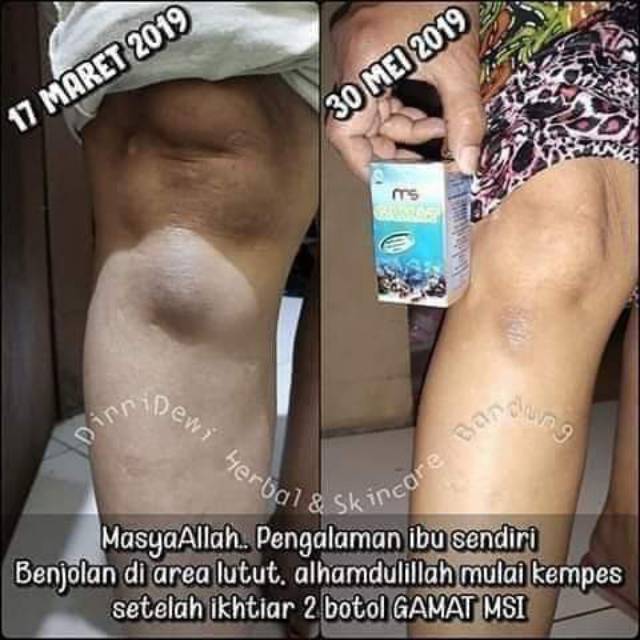 Benjolan Di Lutut Sembuh Berkat Rutin Minum Gamat Shopee Indonesia