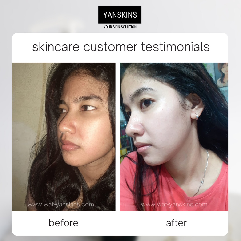 PAKET 5 ITEM SKINCARE BPOM BRIGHTENING SERIES SKIN CARE VARIAN PAKET ACNE FLEK DAN GLOW YANSKINS-8