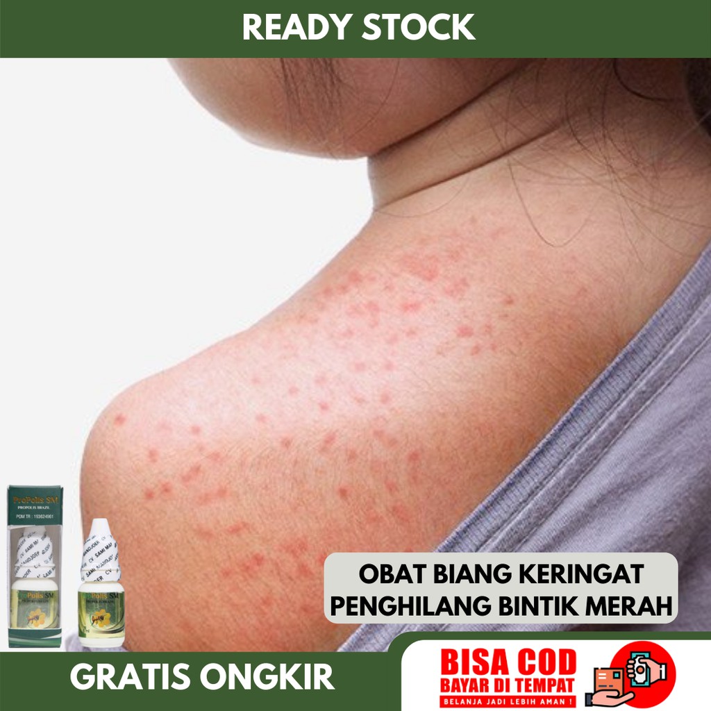 Jual Obat Biang Keringat Penghilang Bintik Merah Kulit Gatal Gatal Bintik Bintik Di Badan 5416