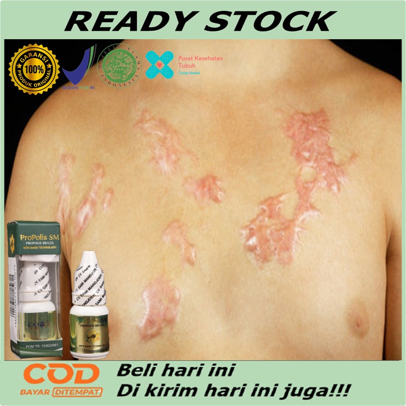 Obat keloid luka bakar - Benjolan Bekas Luka Setelah Sembuh - Obat penghilang luka jatuh - Obat kelo