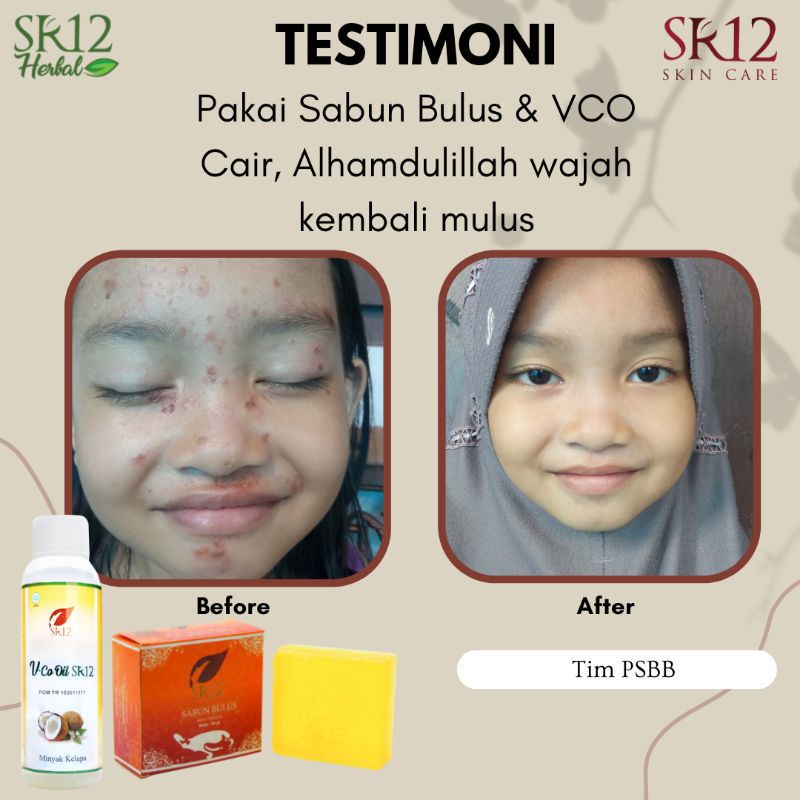 VCO SR12 Untuk Ruam Popok / Minyak Bayi / Biang Keringat / Minyak Kelapa Untuk Bayi / Obat Eksim Bruntusan Dermatitis Kulit Berkerak Bayi Anak