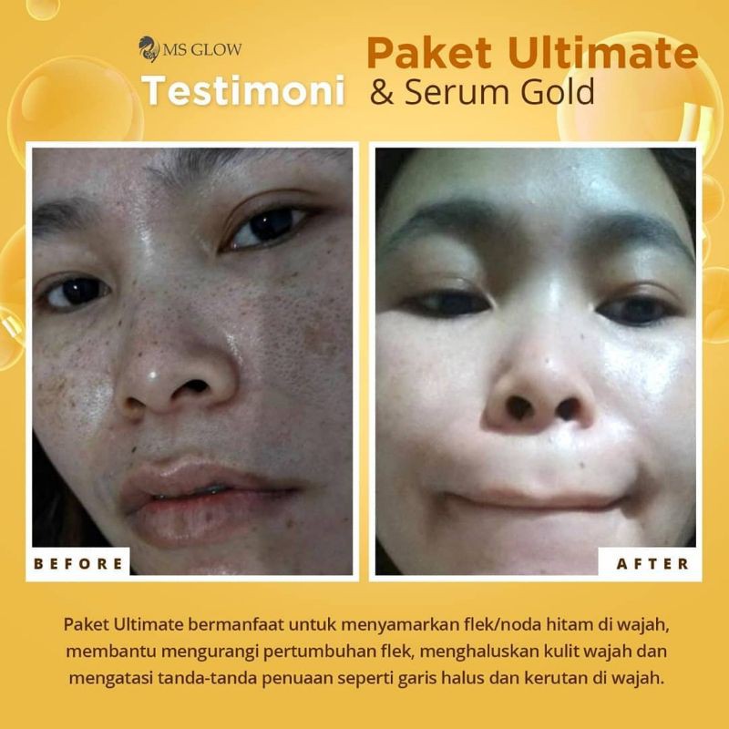 Ms Glow Ultimate Series Skincare Bpom Skincare Halal Skincare Wanita Skincare Medan Shopee Indonesia