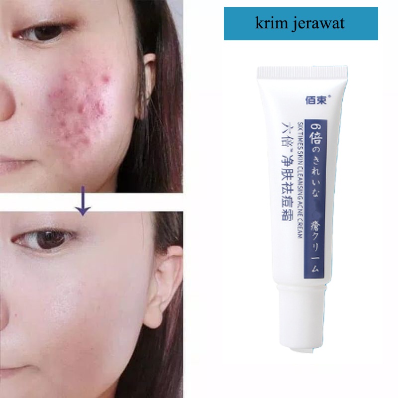 Krim Penghilang jerawat Ampuh 30g AMPUH Penghilang jerawat  permanen untuk wajah berjerawat dan bekas jerawat 6x Krim Jerawat Perbaikan Lemak Hiu Penghilang Jerawat Paling Ampuh Menghilangkan Jerawat dan Bekas Jerawat