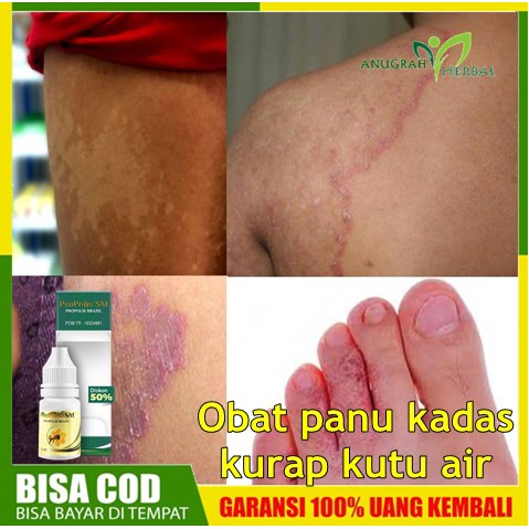 Obat Panu Di Bokong Hilang Permanen, Obat Penghilang Kadas Di Tubuh, Salep Herbal Pembersih Kurap di