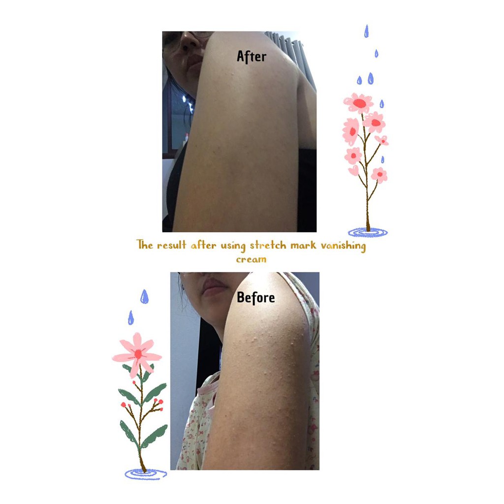 mommy knows best stretch mark vanishing cream