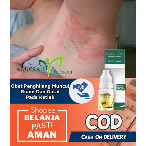 Jual Obat Penghilang Gatal Gatel Merah Pada Ketiak Infeksi Jamur Psoriasis Dermatitis 9320