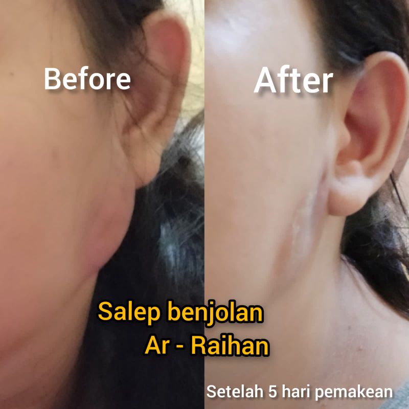 (SALEP BENJOLAN TERLARIS) - SALEP AR-RAIHAN - MENGOBATI BENJO,LAN - KELENJAR - TIROID - GANGLION - GONDOK - TUMOR. minyak .salep benjolan obat benjolan minyak oles lipoma