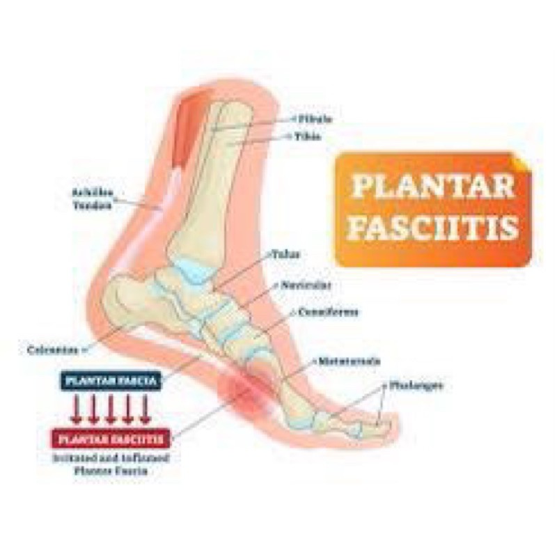 Sandal Kesehatan Oofos Terapi Kaki Plantar Faciitis Shopee Indonesia