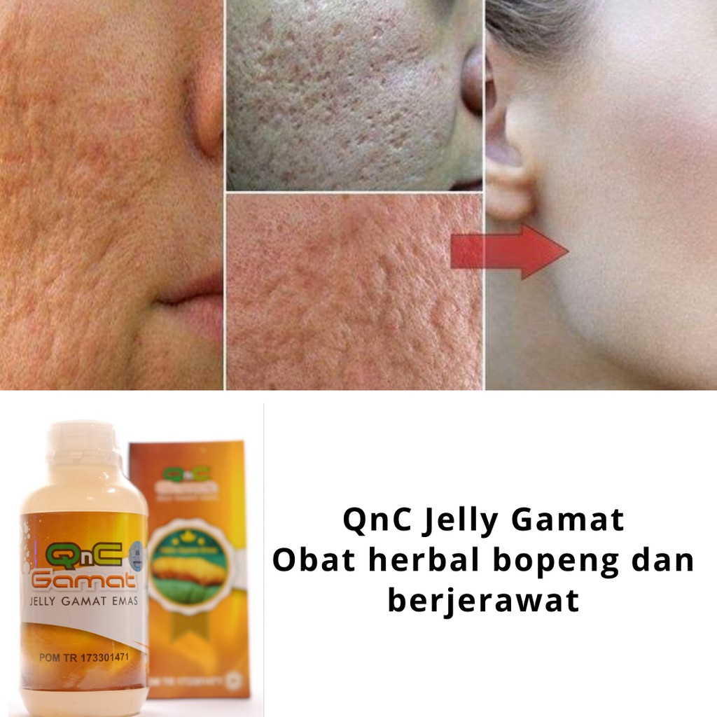 Obat Bopeng Dan Jerawat Alami Qnc Jelly Gamat Emas Asli 100 Original Indonesia