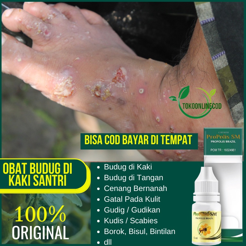 jual-obat-budug-di-kaki-santri-cenang-bernanah-gatal-kulit-anak