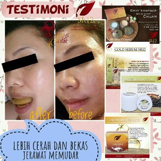 TUMPAS BEKAS JERAWAT , FLEK HITAM &amp; NODA WAJAH ..!! SPOT ESSENCE DAY &amp; NIGHT CREAM SR12 STANDAR BPOM