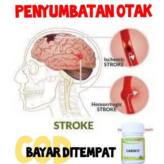 

obat strok obat herbal strok stroke setrok penyumbatan otak penyumbatan kolestrol di otak