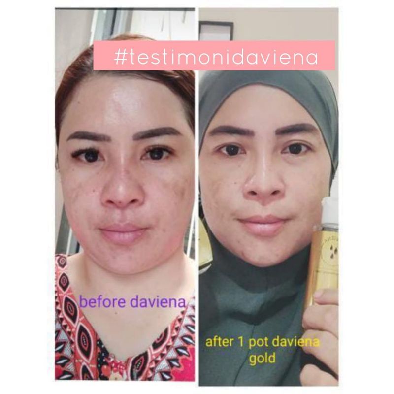 GOLD SERIES DAVIENA SKINCARE//PAKET FLEK/MELASMA-7