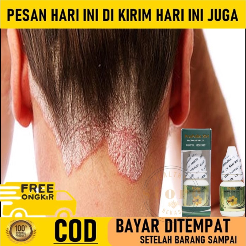 Jual Obat Kurap Di Kulit Kepala Obat Ketombe Berkerak Obat Ketombe Rambut Obat Kepala Berkerak Indonesia Shopee Indonesia