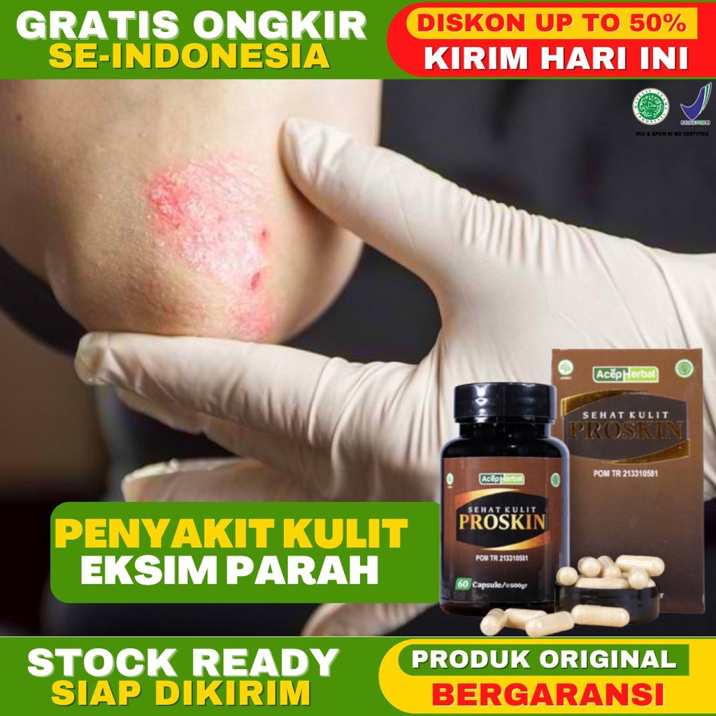 Obat Eksim Parah Eksim Basah Eksim Kering Eksim Menahun Eksim Kronis Penyakit Kulit Infeksi Jamur Ku