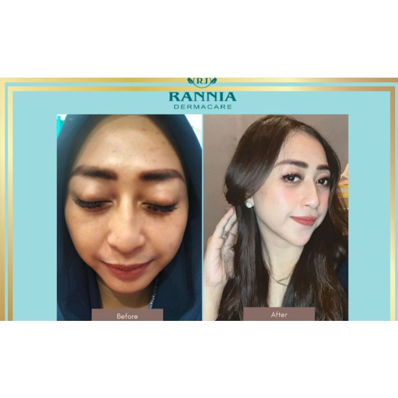 filler dagu 1cc eropa