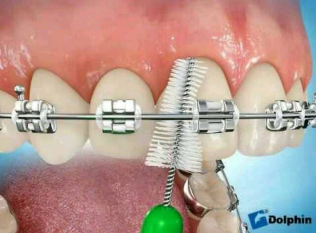 sikat interdental brush / sikat sela behel gigi / sikat kawat gigi dr smith  ortho [ hijau isi 5 ]