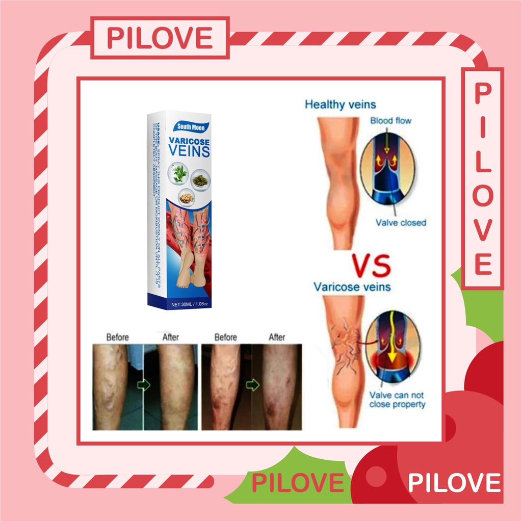 PILOVE - Salep Krim Cream Obat Penyembuh dan Penghilang Varises Parises Angitis Salep Flebitis di Kaki dan Betis Tangan Cream Krim Varises Hasil Paling Ampuh Original Hasil Permanen