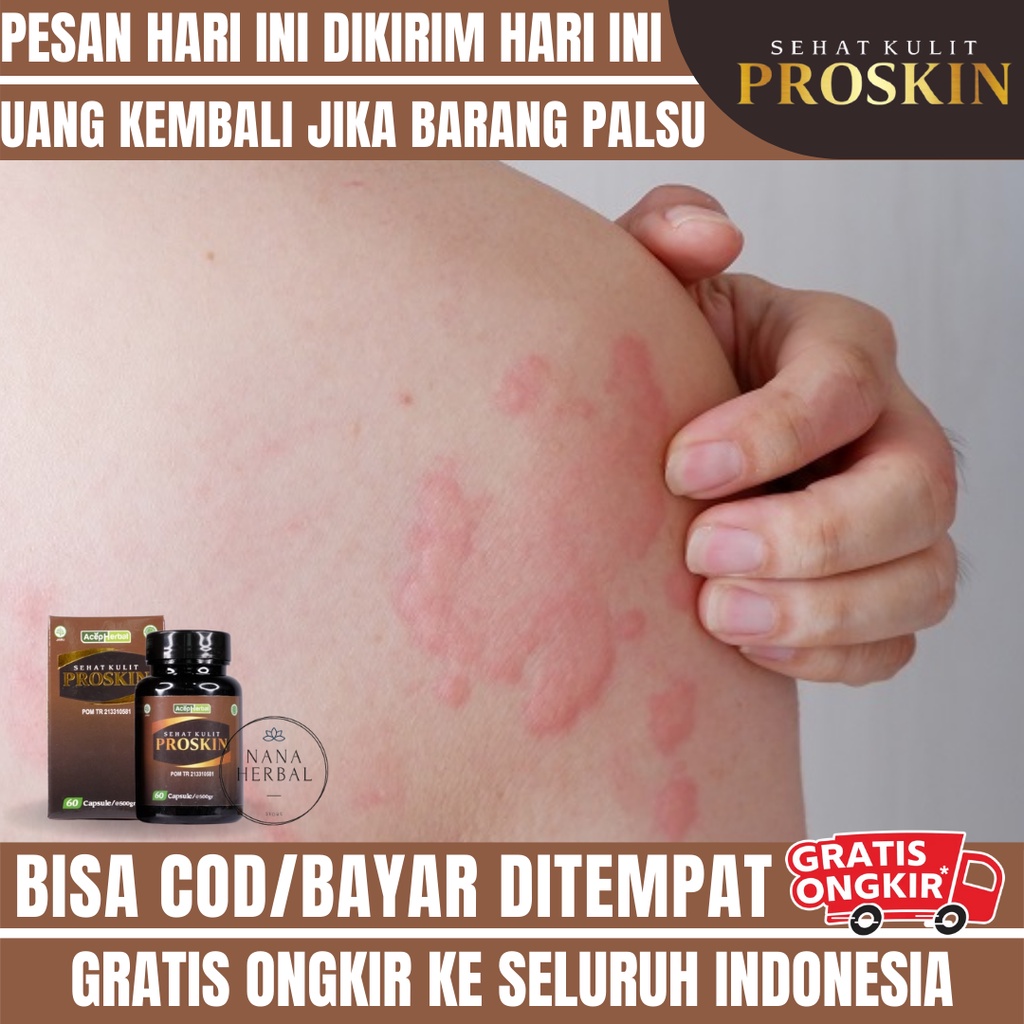 OBAT ALERGI, KULIT BIDURAN, OBAT HERBAL KULIT BENTOL ALERGI, KULIT MERAH MERAH ALERGI, OBAT KALIGATA