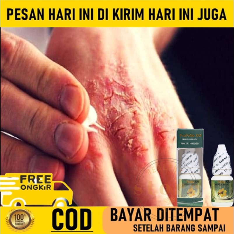 Obat Kudis / Scabies Manusia - Obat Eksim Kering - Obat Gatal Menahun - Obat Gudik Manusia Gatal