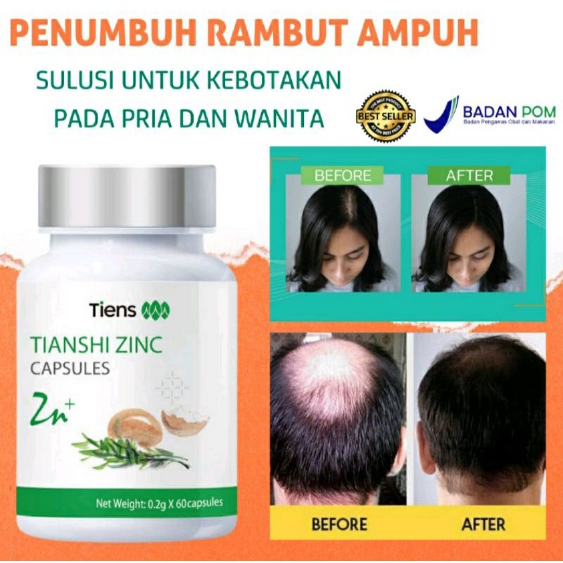 PALING LARIS PENUMBUH RAMBUT HORMON ZINC TIENS  PENUMBUH RAMBUT,BREWOK,KUMIS DAN ALIS DALAM 7 HARI.