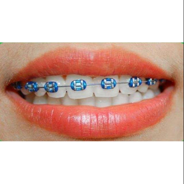 Best Seller Behel Fashion Metal Ortho Original Biru Tua Metalik Atas Saja Untuk Cewek Cowok Shopee Indonesia