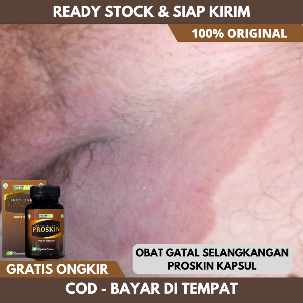 Obat gatal selangkangan hitam, obat selangkangan hitam dan gatal, obat selangkangan berjamur, obat s