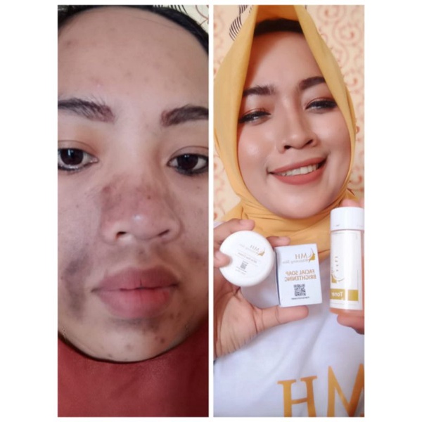 MH whitening