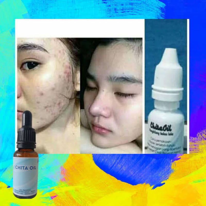 HOT PROMO Chita oil penghilang bekas luka keloid