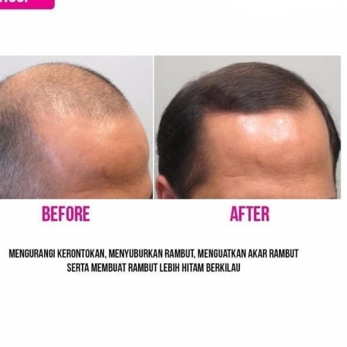 ➨ BMKS Hair Tonic Kemiri Original - Hair Tonic Kemiri BMKS Original ✺