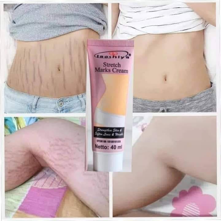 penghilang strechmark ( LAOSHIYA ) salep penghilang bekas luka penghilang keloid penghilang selulit 