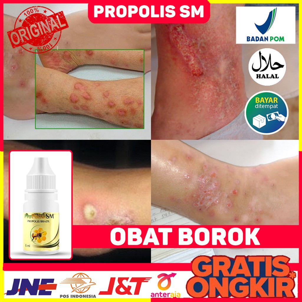 Obat Borok - Borok Bernanah - Borok Berair - Luka Bernanah - Obat Borok Pada Kaki - Borok di Tangan 