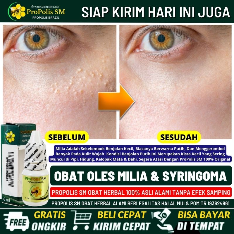 Obat Tetes Untuk Milia 100% Asli Alami - Penghilang Milia, Syringoma, Kanker Kulit Kista, Bruntusan 