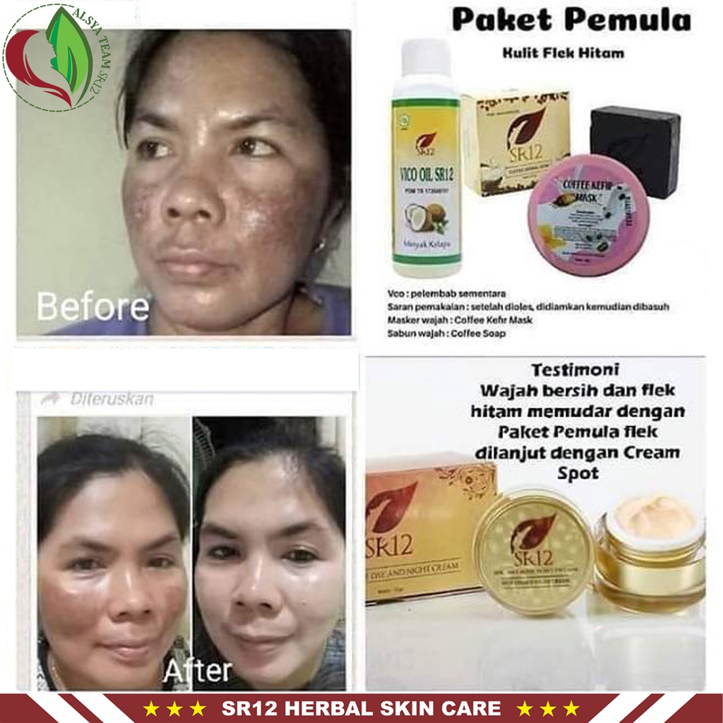 Spot Essence SR12 | Spot Essence Day Cream &amp; Spot Essence Night Cream | Krim Wajah SR12 Skincare